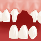 Pose du pont dentaire