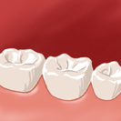 La dent est remplacée