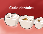 Carie dentaire