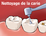 Nettoyage de la carie