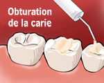 Obturation de la carie