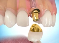 Mise en place du pilier