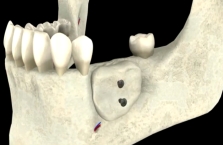 Mise en place de la greffe osseuse