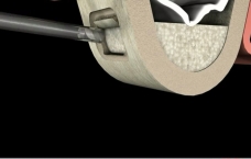 Mise en place de la greffe sinusienne