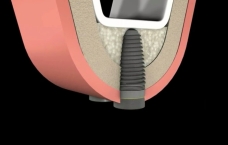 Mise en place de l'implant dentaire