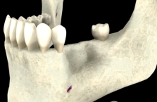 Volume osseux insuffisant