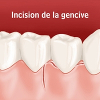 Incision de la gencive