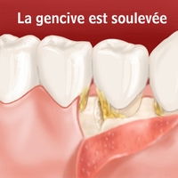 La gencive est soulevée