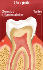 Gingivite
