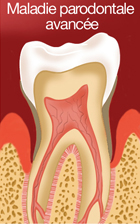 Maladie parodontale avancée