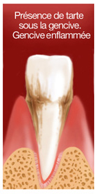 Présence de tartre sous la gencive. Gencive enflammée