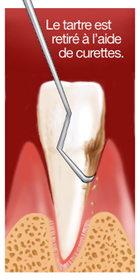 Le tartre est retiré à l'aide de curettes