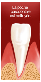 La poche parodontale est nettoyée